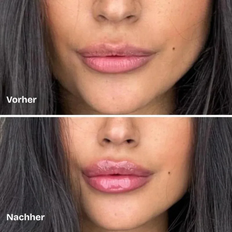 Lippen vorher und nachher